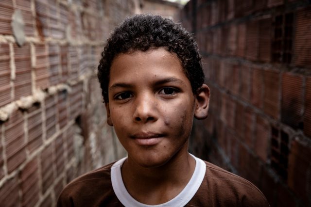 Miguel uit Brazilie heeft door lepra donkere vlekken in zijn gezicht